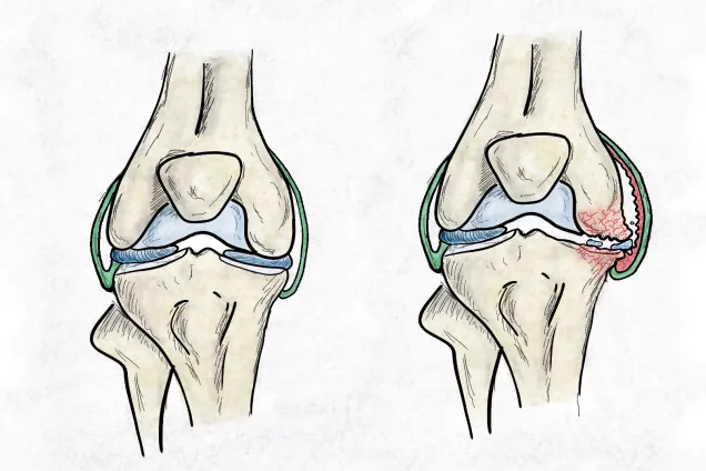 En illustration på insidan av ett friskt knä till vänster och ett artrosdrabbat knä till höger. Det artrosdrabbade knät visar bland annat en inflammerad ledkapsel och en trasig menisk.