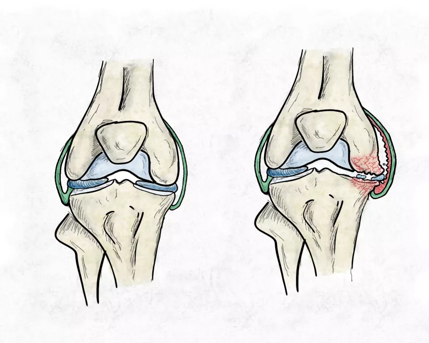 En illustration på insidan av ett friskt knä till vänster och ett artrosdrabbat knä till höger. Det artrosdrabbade knät visar bland annat en inflammerad ledkapsel och en trasig menisk.