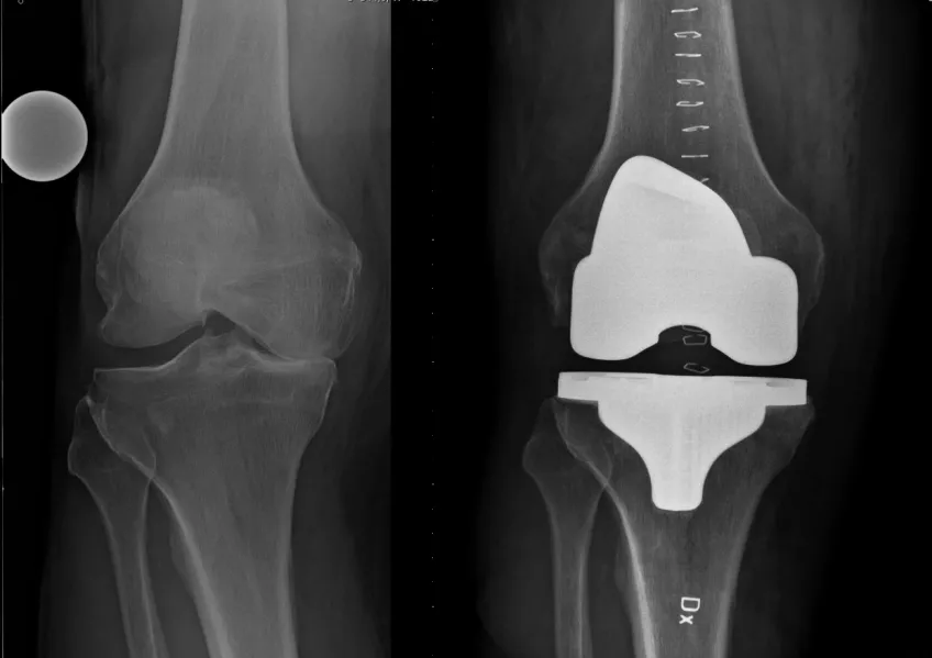 Röntgenbild som visar ett knä utan protes och ett knä med protes.