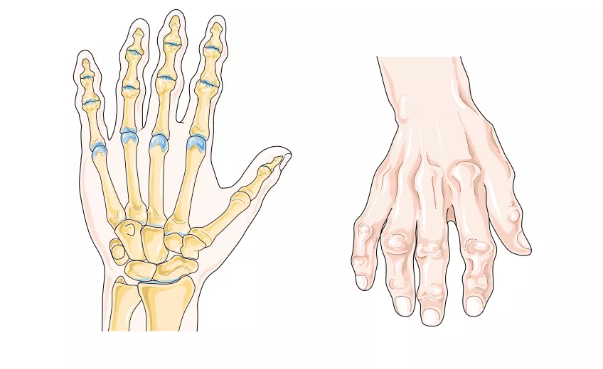 Illustration på två händer. Den till vänster är en illustrerad röntgenbild som visar artros i olika leder i handen. Den till höger är en illustration på en artrosdrabbad hand.