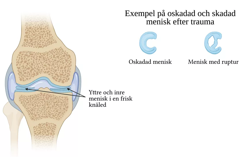 meniskskada